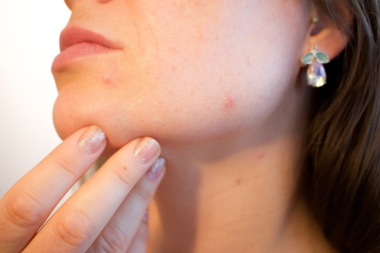 acne, pores, skin, Ingrown Toenail Pus
